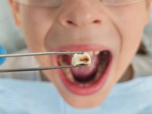 Best Emergency Treatment for Dental Infections or Abscesses in Burnham, IL